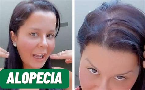 Mara Sa Da Dupla Maiara Revelou Ter Alopecia Entenda A Condi O