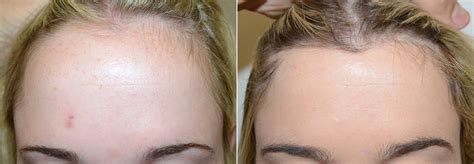 Forehead Reduction Surgery Photos Miami FL Patient54163