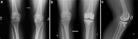 Case 1 Preoperative A And Initial 4 Week Postoperative B C Download Scientific Diagram