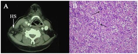 Histiocytic Sarcoma Of The Neck A Case Report