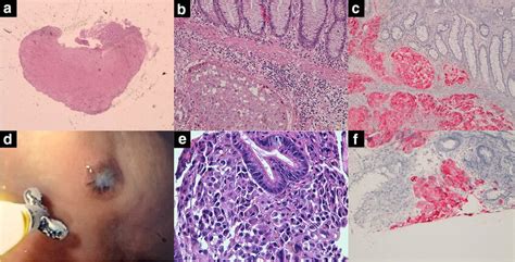 A Polyp In The Right Colon With Melanoma Invading The Submucosa