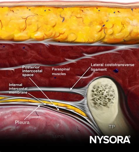 Conseils pour le bloc paravertébral thoracique balayage transversal