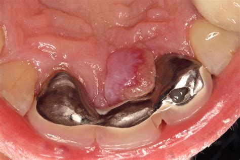 Pyogenic Granuloma Lips Pathology Outlines Lipstutorial Org