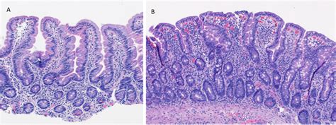 A Normal Duodenal Biopsy With Villous To Crypt Ratio 41 B Celiac