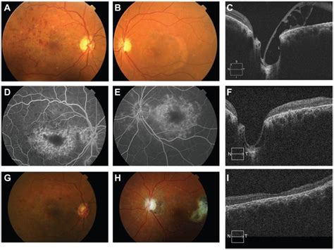 Macular Schisis And Detachment Associated With Presumed Acquired Optic