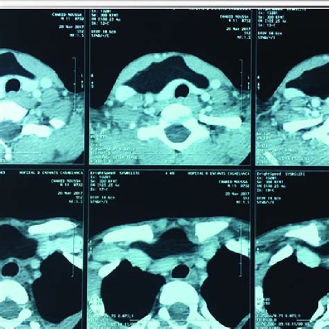 Computed Tomography Scan Shows A Well Circumscribed And Located Masse