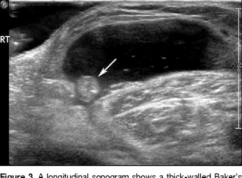 Baker's Cyst On Ultrasound