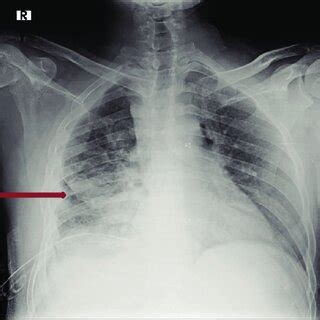 Posteroanterior View Of Chest Radiograph Of October Showing