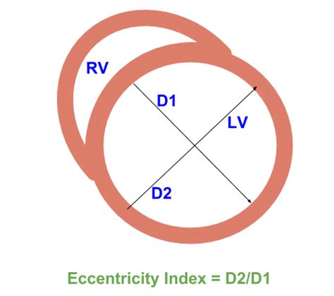 Eccentricity Index For Right Ventricular Overload All About