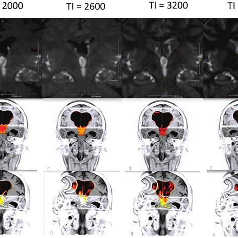 Idiopathic Normal Pressure Hydrocephalus In A 78 Year Old Man Download Scientific Diagram