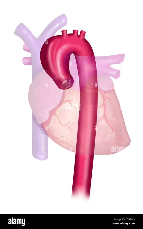 Aneurysm Of The Aortic Arch Stock Photo Alamy