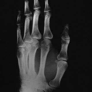 Radiograph Of The Left Hand Does Not Reveal Any Bony Lesion In The