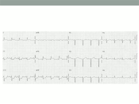 Ecg In Acute Myocardial Infarction Ppt