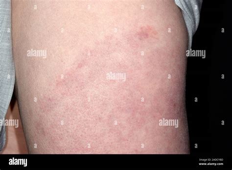 Rash In Lymes Disease In A 59 Year Old Woman Lyme Disease Is Caused