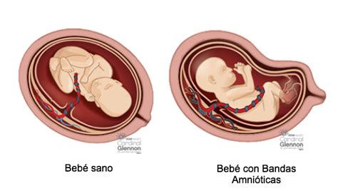 Bandas Amni Ticas S Ndrome De Bandas Amni Ticas Infogen