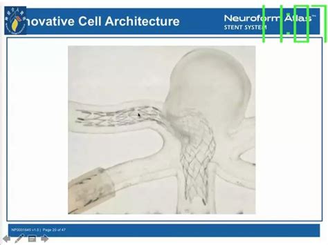 Neuroform Atlas支架治疗颅内动脉瘤