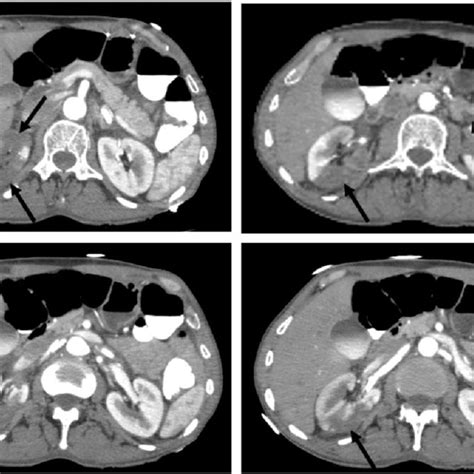 Pdf Bilateral Renal Infarction An Uncommon Presentation Of Fibromuscular Dysplasia