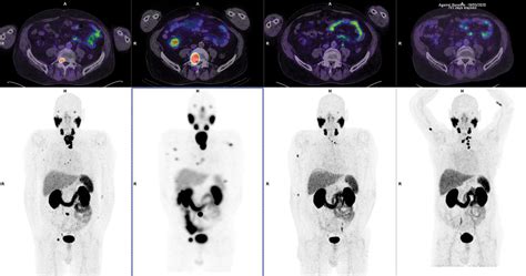 Emerging Potential Of Prostate Specific Membrane Antigen Targeted