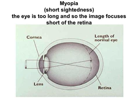 The Complete Guide to Understanding Nearsightedness: Exploring the ...