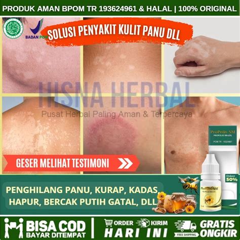 Jual Obat Panu Di Wajah Anak Bayi Dan Dewasa Menghilangkan Panuan Pada