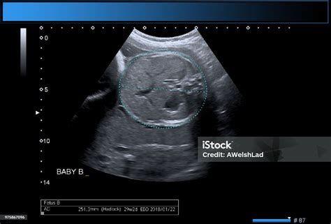 Identical Twin Boys Obstetrical Ultrasound Stock Photo - Download Image ...