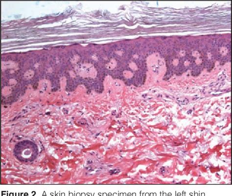 Ichthyosis Vulgaris Histology