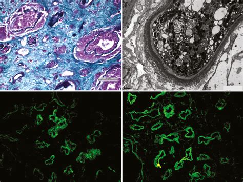 Iga Kappa Light And Heavy Chain Deposition Disease In Multiple Myeloma