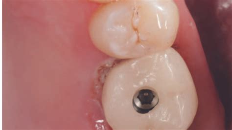 Screwmentable Implant Crowns Decisions In Dentistry