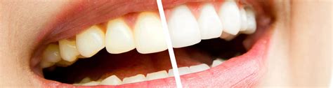 Tooth Discoloration Or Stained Teeth Treatments To Remove Stains