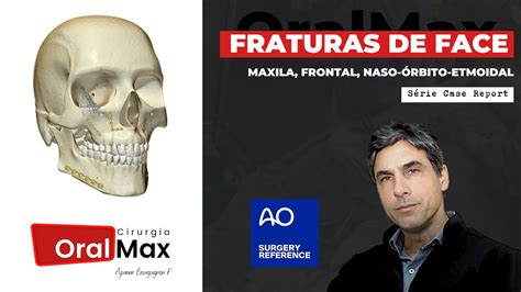 Fraturas De Face Maxila Frontal Naso Rbito Etmoidal E Rbita