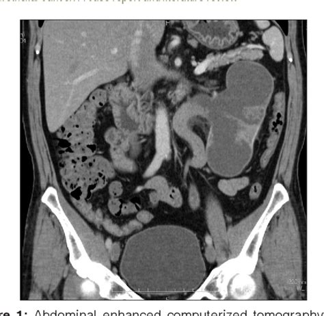 Figure 1 From Superior Vena Cava Syndrome Due To Metastasis From