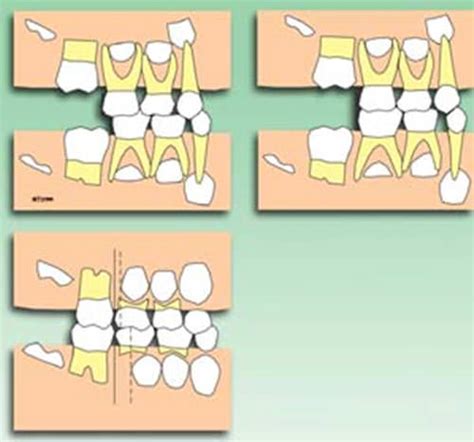 Desarrollo De La Dentición La Dentición Primaria