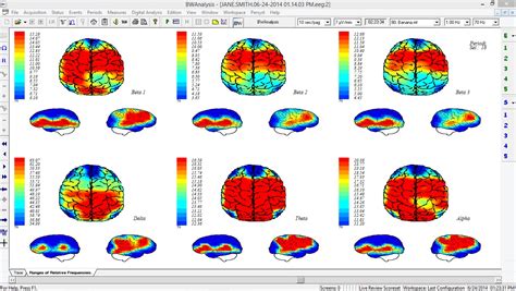 Que Es El Mapeo Cerebral Electroencefalograma Nbkomputer