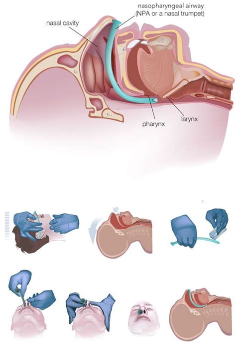 Airway Management Airway Management Emergency Nursing Emt Paramedic