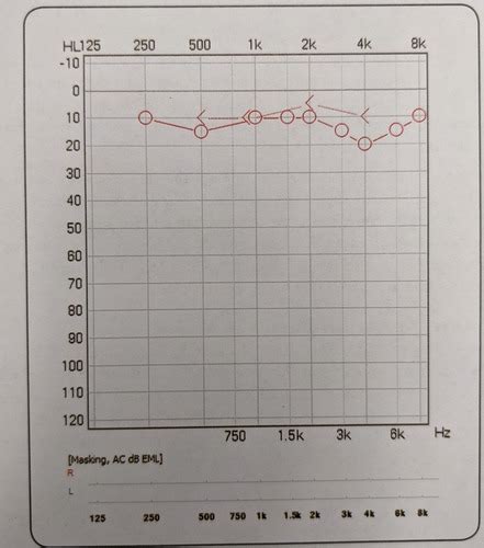 Different Types Of Audiograms And Hearing Loss Flashcards Quizlet