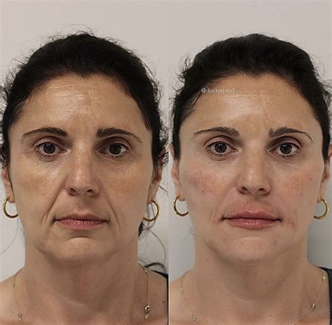 Non Surgical Facelift Procedures Vancouver One Clinic Md