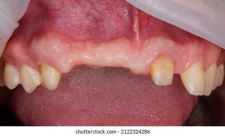 Larynx Throat Glands Tongue Viral Lingitis Stock Photo 1446528689