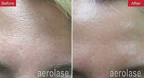 Aerolase Laser - Oval Medical Laser Aesthetics