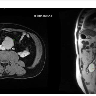 Axial And Sagittal View Of MRI Abdomen Showing A 5 4 X 5 1 X 4 1cm T1