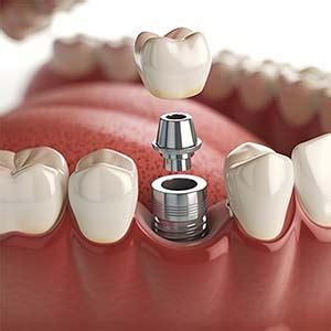 Are Dental Implants Safe Dr Michael Koumas Dds Pc