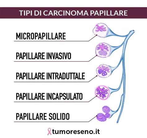 Carcinoma Papillare Tumore Seno