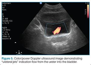 Kidney Stone Ultrasound