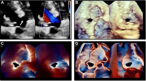 Clinical Utility Of Transillumination On Transthoracic Imaging Case