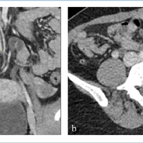 Prestenotic Dilation Of The Left Common Iliac Vein 1 Dilated