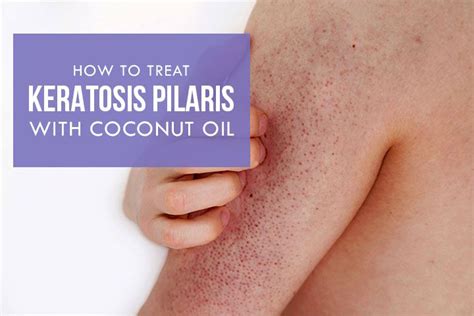 How To Use Coconut Oil For Keratosis Pilaris Keratosis Pilaris