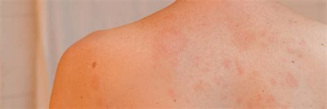 Pityriasis Rosea The Dermatology Center Of Indiana