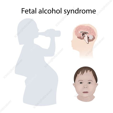 Foetal Alcohol Syndrome Illustration Stock Image F