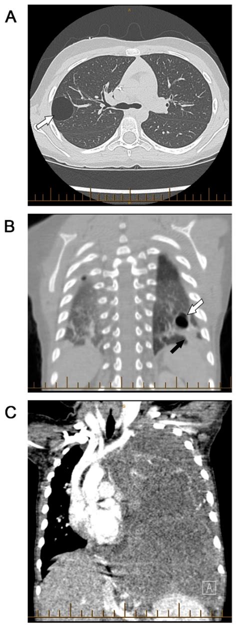 Current Management Of Pleuropulmonary Blastoma A Surgical Perspective