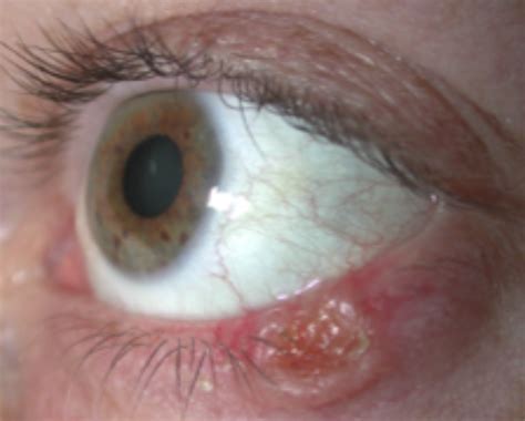 Nodular Basal Cell Carcinoma Of The Eyelid