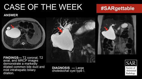 Society Of Abdominal Radiology Sar On Twitter The Answer To Last